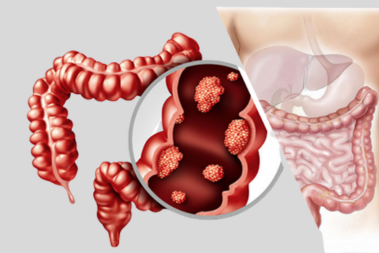 colorectal Cancer