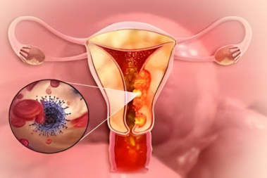 Endometrial Cancer