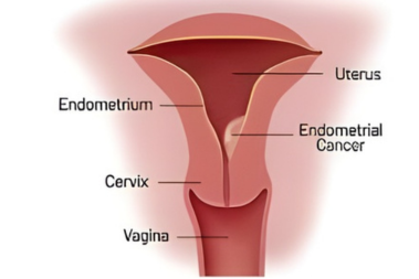 Endometrium Cancer